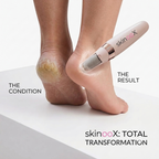 Callus Remover